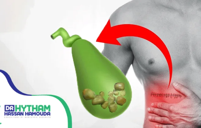 تجربتي-مع-استئصال-المرارة