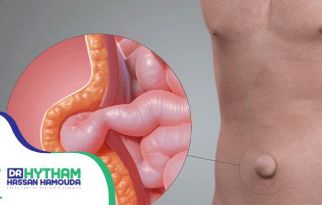 تجربتي-مع-الفتق-السري