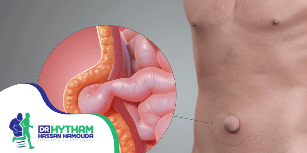 تجربتي-مع-الفتق-السري