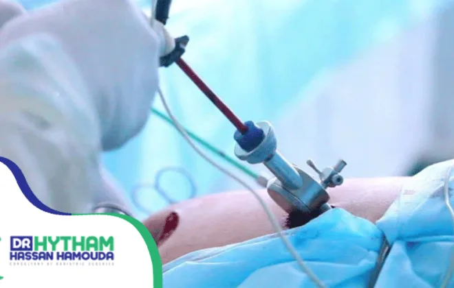 تكلفة عملية الفتق الاربي بالمنظار