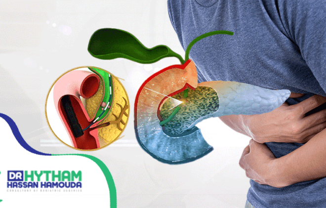 عملية-‏استئصال-المرارة