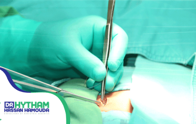 مدة الشفاء من عملية الفتق الاربي