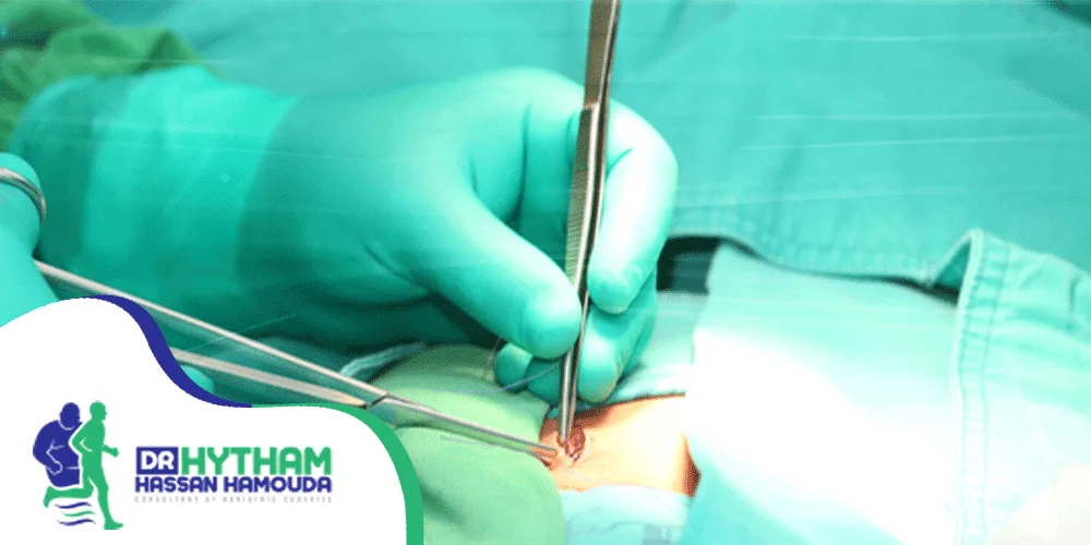 مدة الشفاء من عملية الفتق الاربي