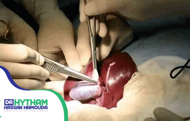 نصائح-بعد-استئصال-المرارة