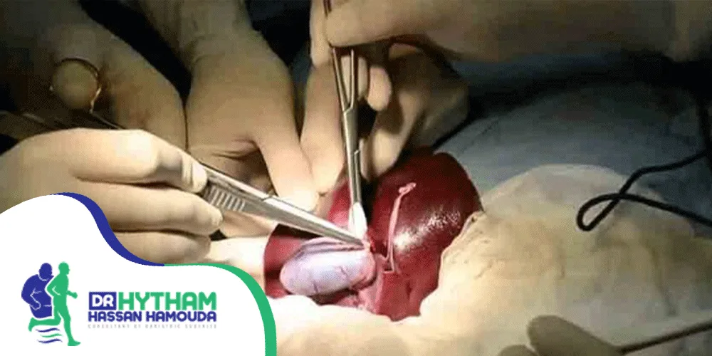 نصائح-بعد-استئصال-المرارة