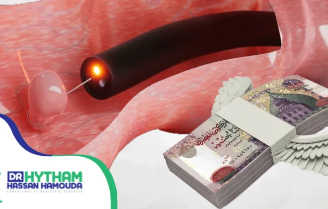 تكلفة عملية استئصال ورم القولون