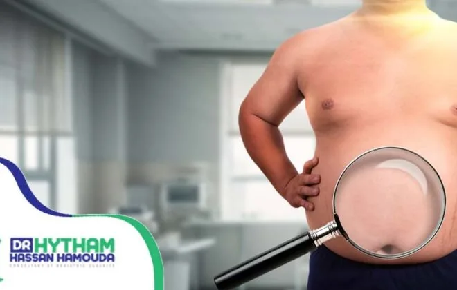 التئام المعدة بعد عملية التكميم-عملية التكميم المعدل