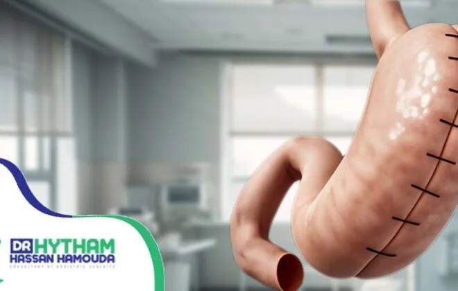 عملية التكميم المعدل-عملية التكميم المغلف