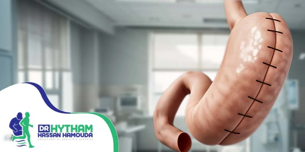 عملية التكميم المعدل-عملية التكميم المغلف