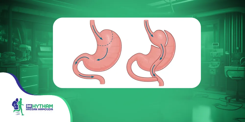 الفرق بين تحويل المسار الكلاسيكي والمصغر