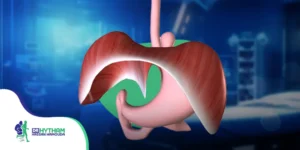 ما هو فتق الحجاب الحاجز