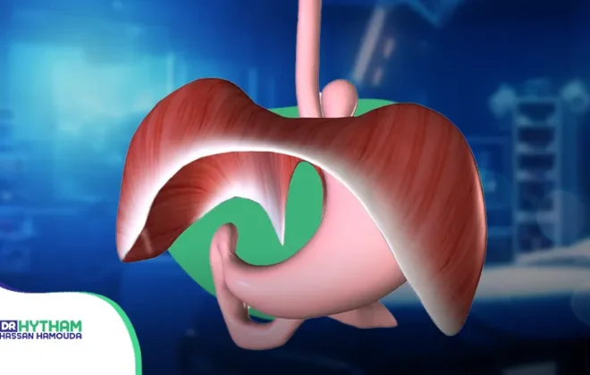 ما هو فتق الحجاب الحاجز