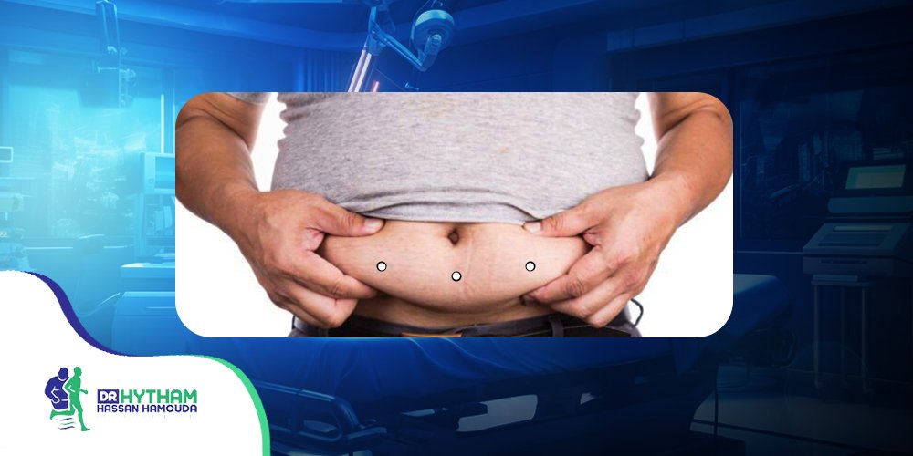 عملية-التكميم-البكيني عملية التكميم البكيني